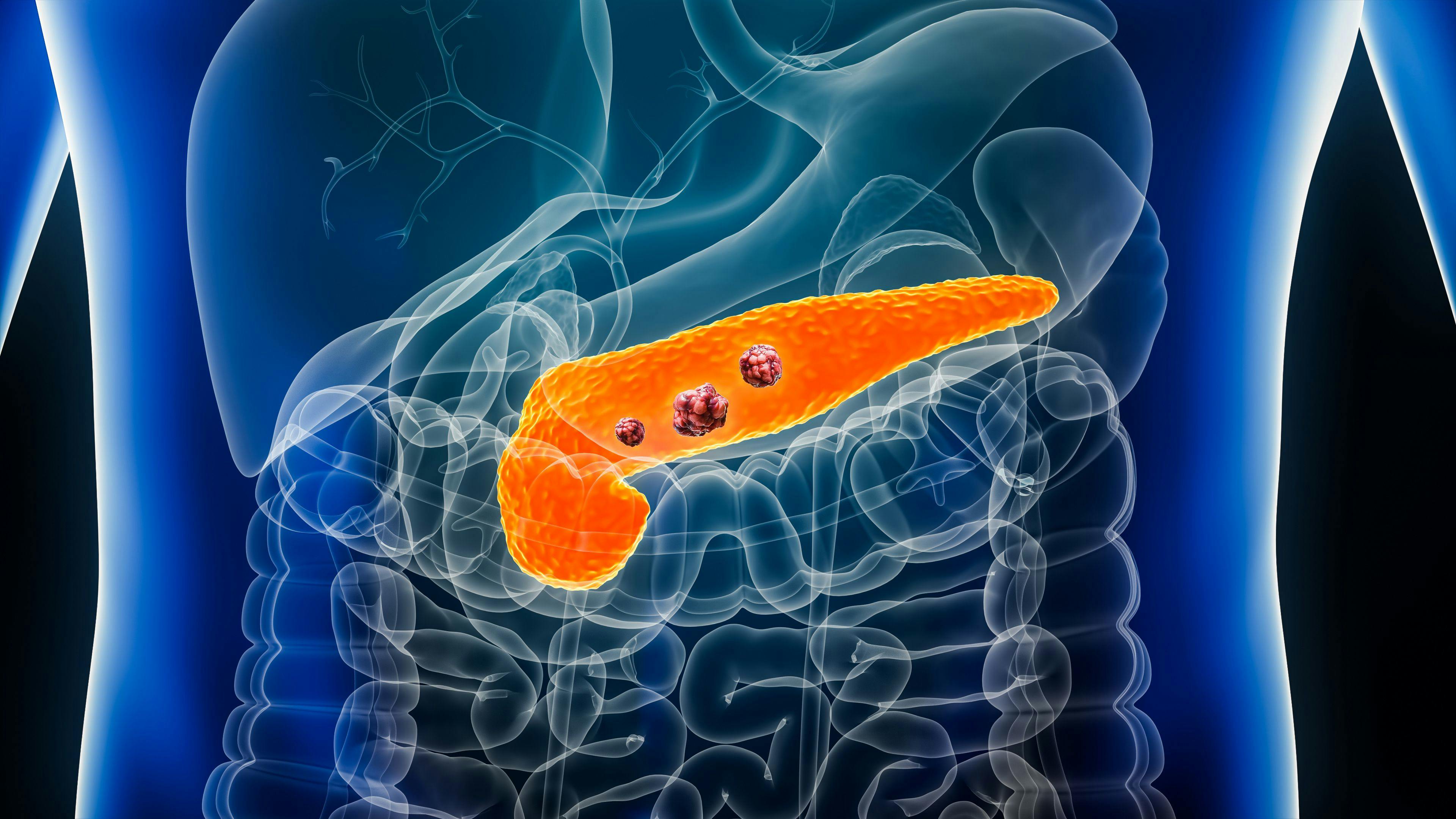 Pancreas or pancreatic cancer with organs and tumors or cancerous cells 3D rendering illustration with male body. Anatomy, oncology, disease, medical, biology, science, healthcare concepts. | Image Credit: © Matthieu - stock.adobe.com