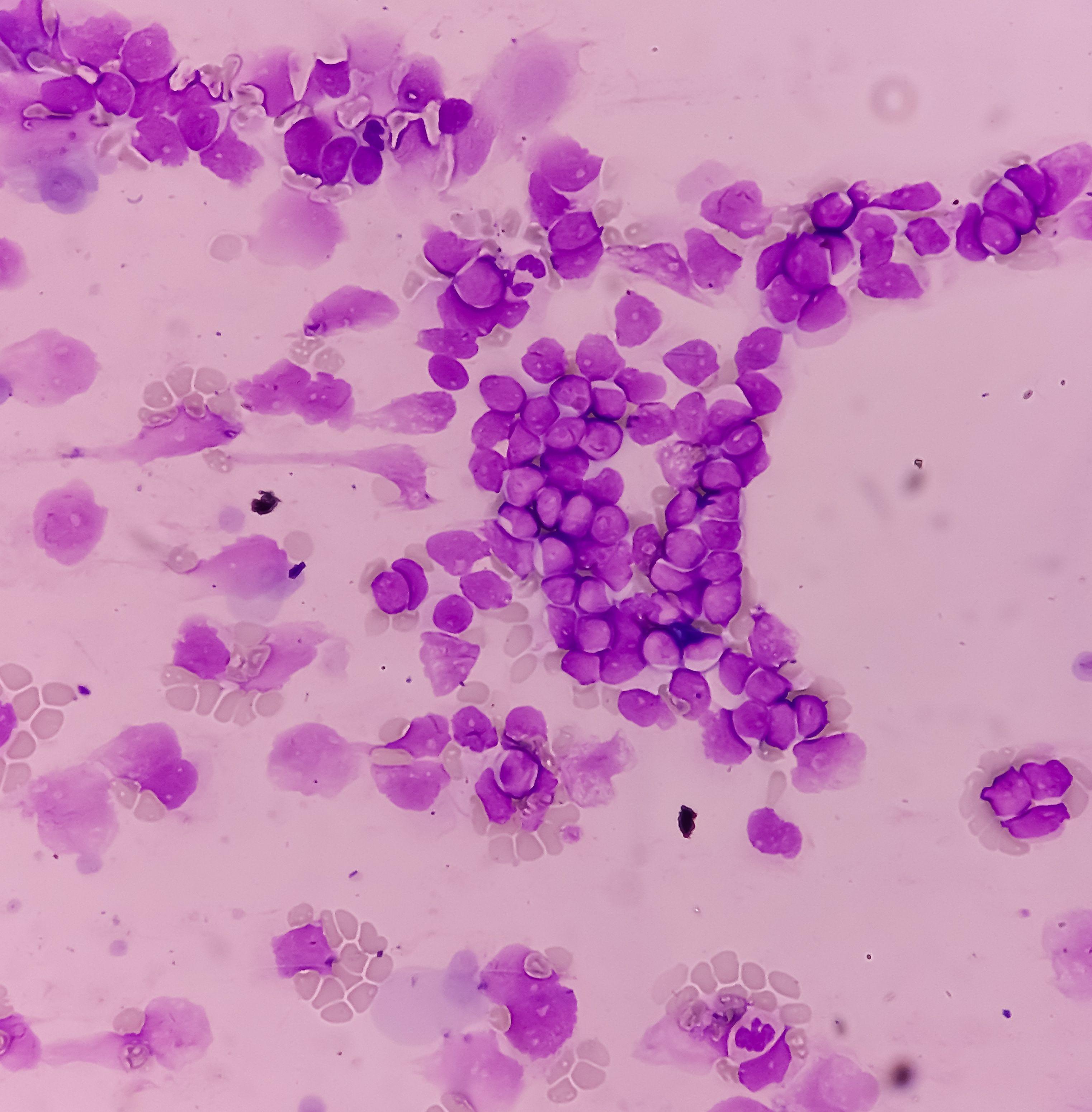 Acute leukemia, ALL(Acute lymphoblastic leukemia), peripheral blood smear, Under 100x light microscope to diagnosis of Acute leukemia. | Image Credit: © MdBabul - stock.adobe.com