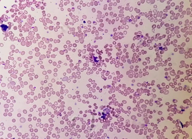 Microscopic view of hematological slide showing Pancytopenia. A condition in which there is a lower number of RBC, WBC and platelets in the blood. | Image Credit: © Saiful52 - stock.adobe.com.